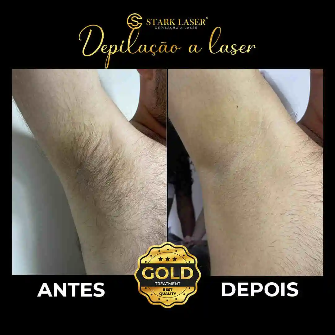 Depilacao A Laser Antes E Depois Antes E Depois Do Tratamento Com
